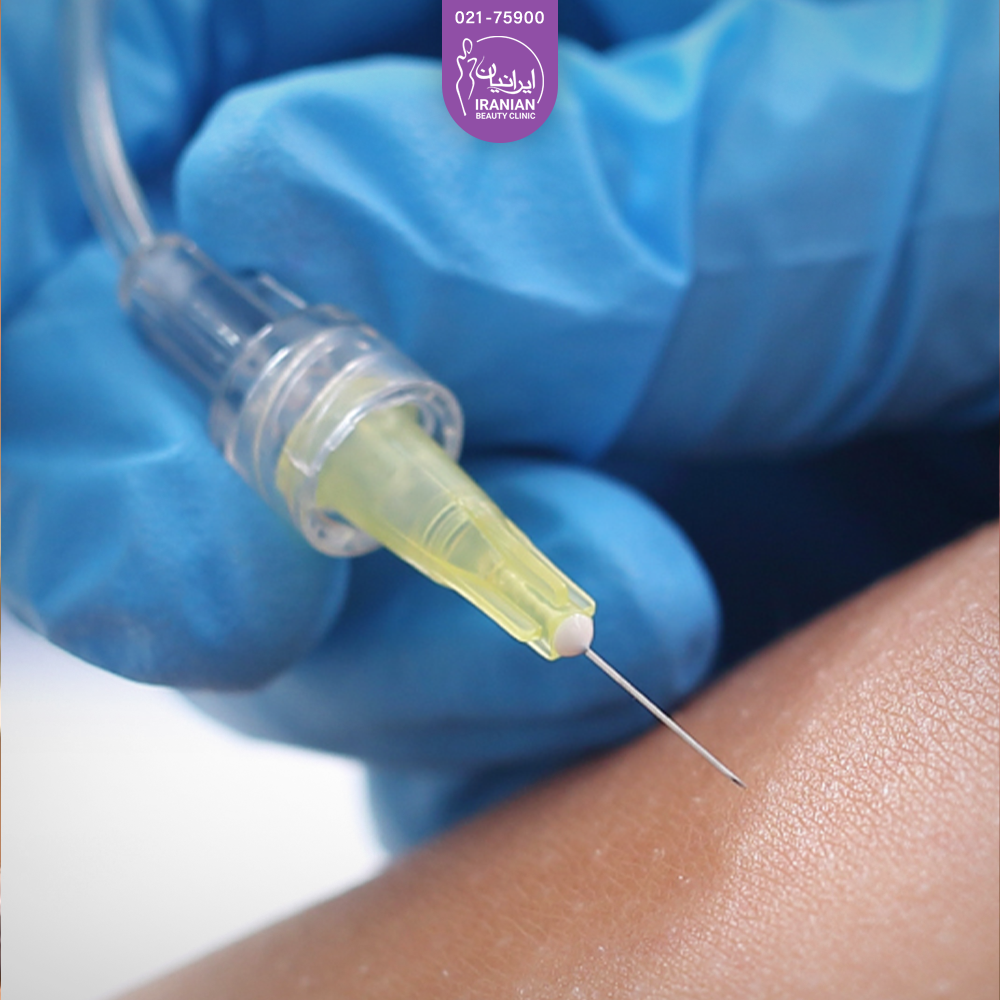 دستان دکتری که دستکش آبی دارد و در حال انجام کربوکسی تراپی است - کربوکسی تراپی سلولیت​