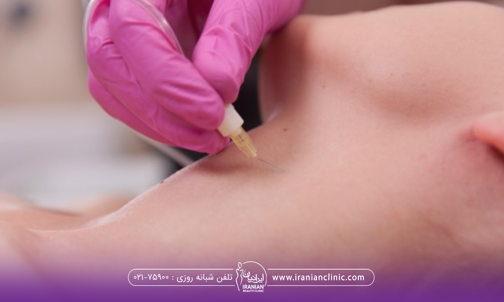 دست دکتری که در حال کربوکسی تراپی روی گردن فرد است - مدت ماندگاری کربوکسی تراپی
