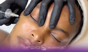دستان دکتری که یک دست روی صورت خانمی که خوابیده است و دست دیگر در حال انجام کربوکسی تراپی است - هزینه کربوکسی تراپی
