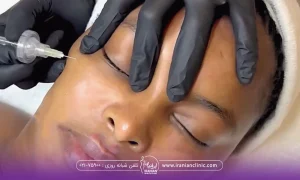 دستان دکتری که یک دست روی صورت خانمی که خوابیده است و دست دیگر در حال انجام کربوکسی تراپی است - هزینه کربوکسی تراپی