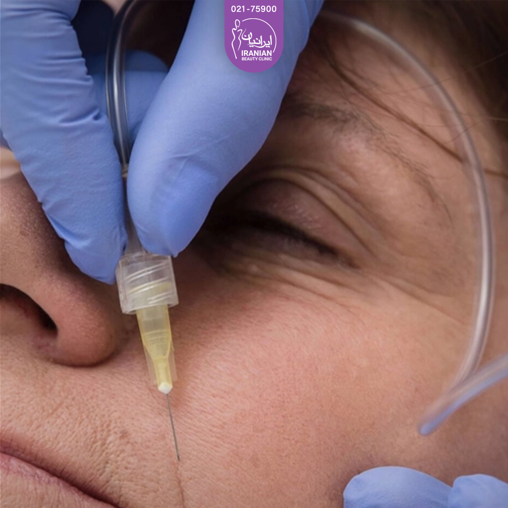 دستان دکتری که در حال انجام کروبسی تراپی صورت فردی است که خوابیده است - کربوکسی تراپی جای جوش