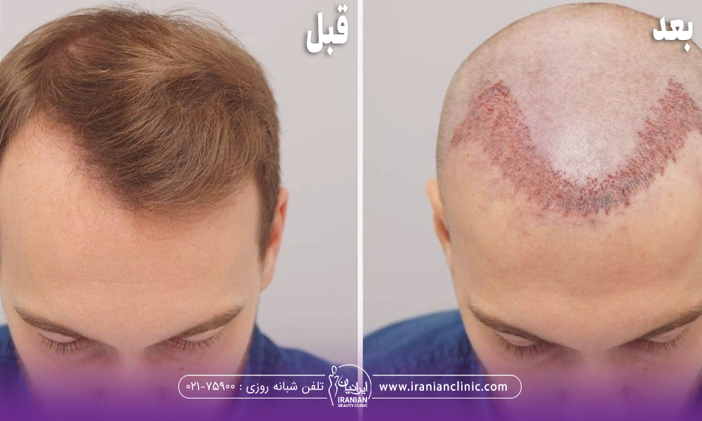 عکس قبل و بعد فردی که کاشت مو انجام داده است - جوش بعد از کاشت مو​