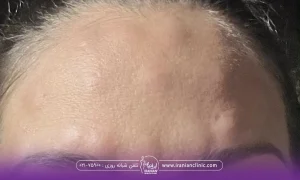 پیشانی دختر که روی پوست او ورم هایی مشخص است - ورم پیشانی بعد از بوتاکس​