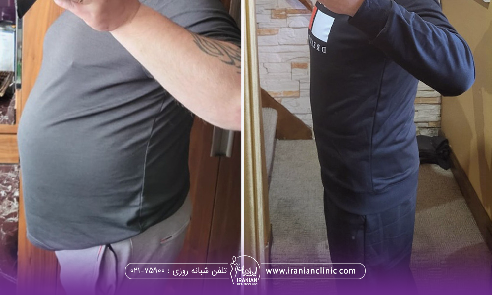 عکس قبل و بعد مردی که بوتاکس معده انجام داده است
