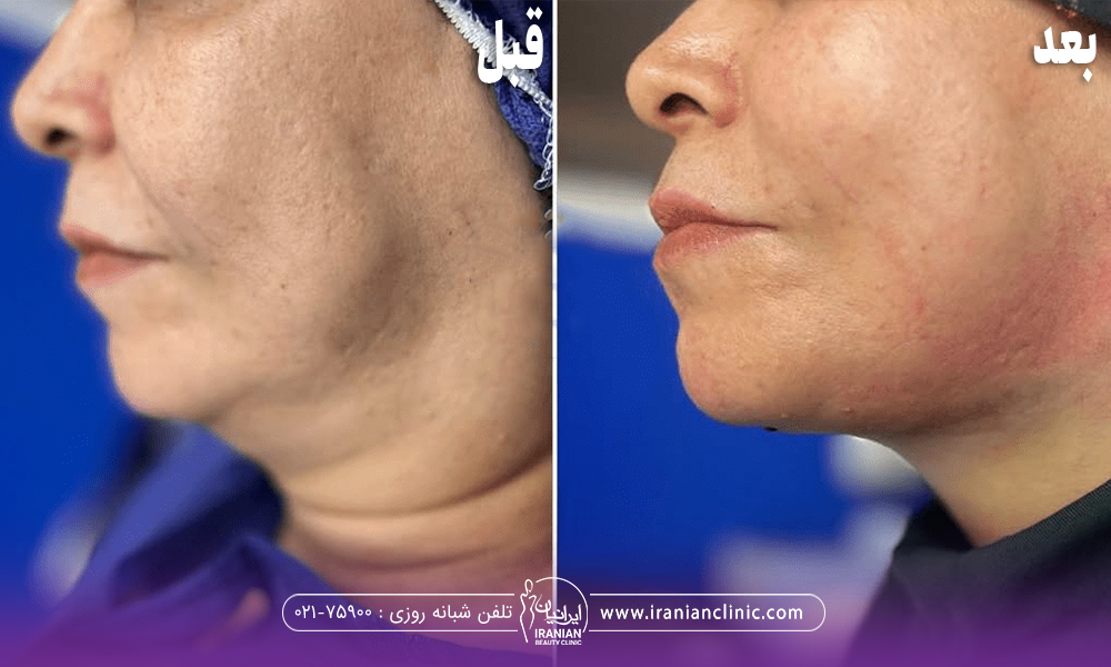 عکس قبل و بعد لیپوماتیک غبغب زن