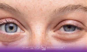 عکس قبل و بعد فردی که بعد از تزریق بوتاکس چشم او دچار افتادگی شده است - افتادگی پلک بعد از بوتاکس​