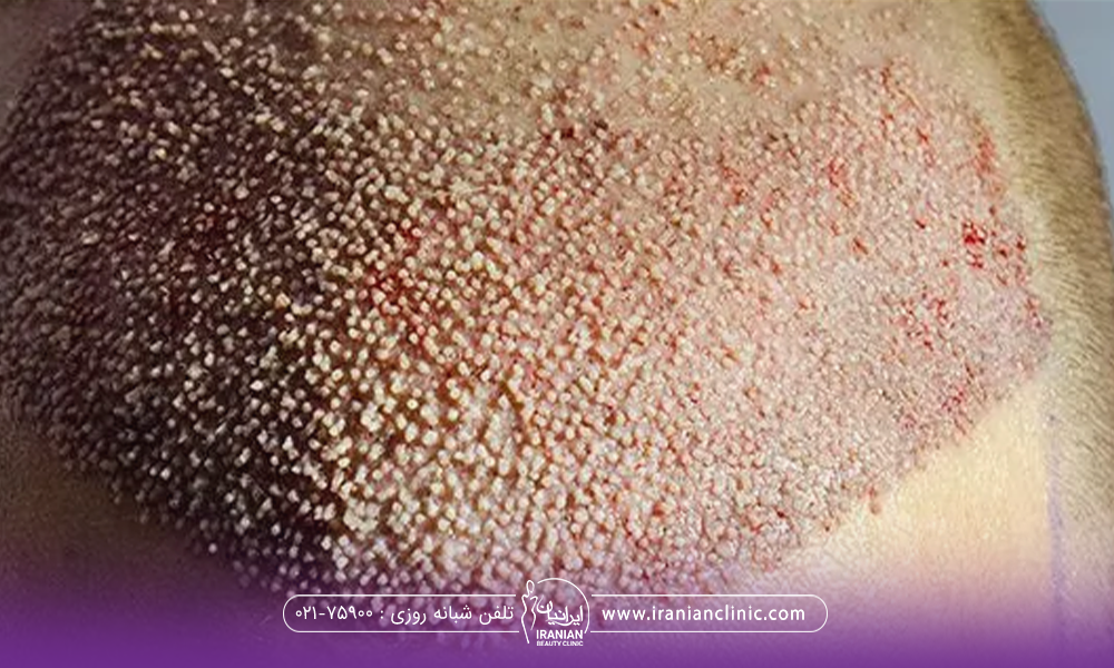 عکس از سر فردی که تازه کاشت مو انجام داده است - دست زدن به موهای کاشته شده