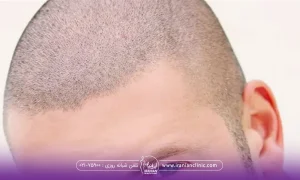 عکس از سر مردی که مو کاشته است - ضربه به سر بعد از کاشت مو