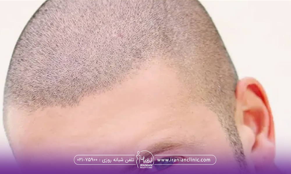 عکس از سر مردی که مو کاشته است - ضربه به سر بعد از کاشت مو