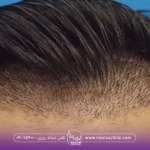 How long does it take for a hair graft to solidify