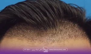 How long does it take for a hair graft to solidify