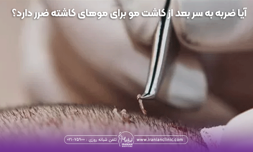 پزشکی که گرافت های مو را روی سر فرد می کارد