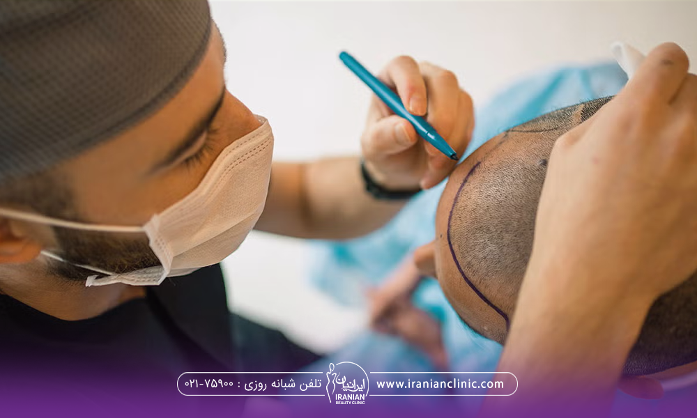 پزشکی که قبل از کاشت روی سر مرد با ماژیک طراحی انجام می دهد