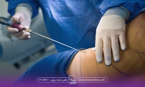 فردی که خوابیده و دستان جراحی که در حال انجام لیپوماتیک است - هزینه لیپوماتیک