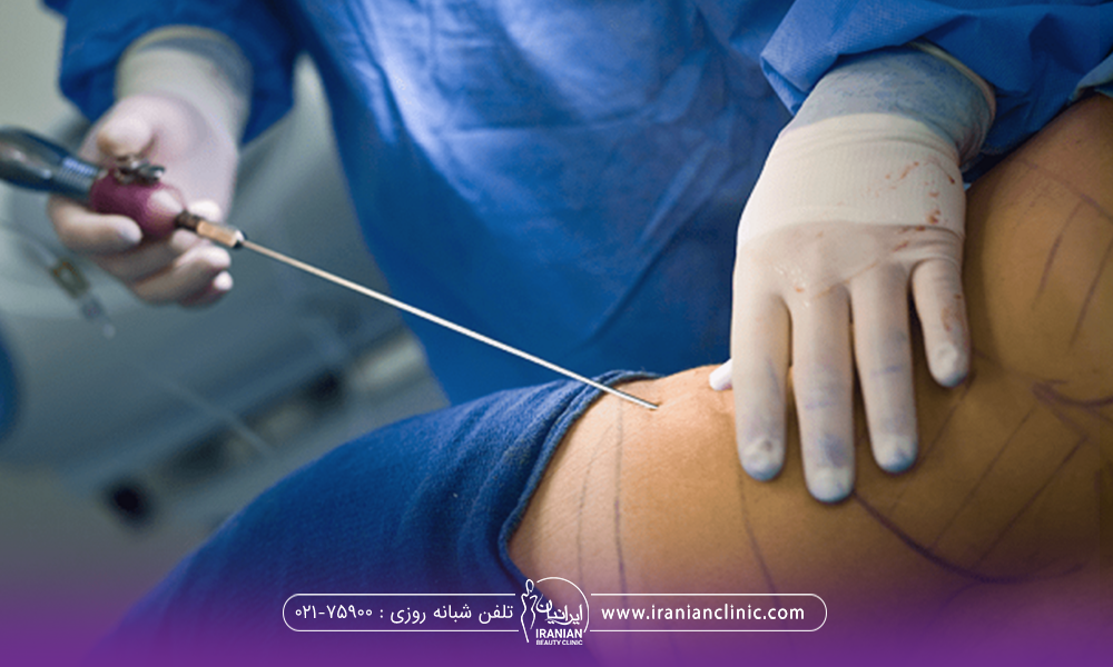 فردی که خوابیده و دستان جراحی که در حال انجام لیپوماتیک است - هزینه لیپوماتیک