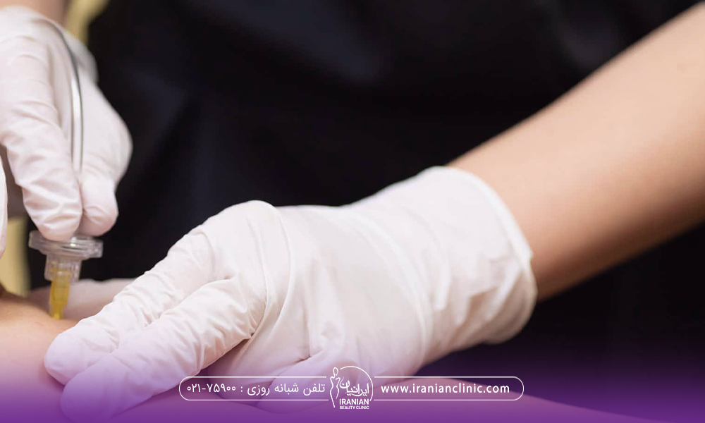 پزشکی که پای فرد را کربوکسی تراپی می کند