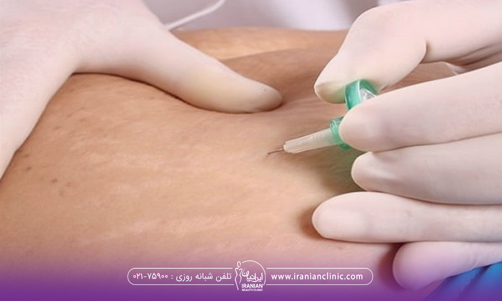 عکس شکم فرد در حالی که پزشک کربوکسی تراپی شکم انجام می دهد