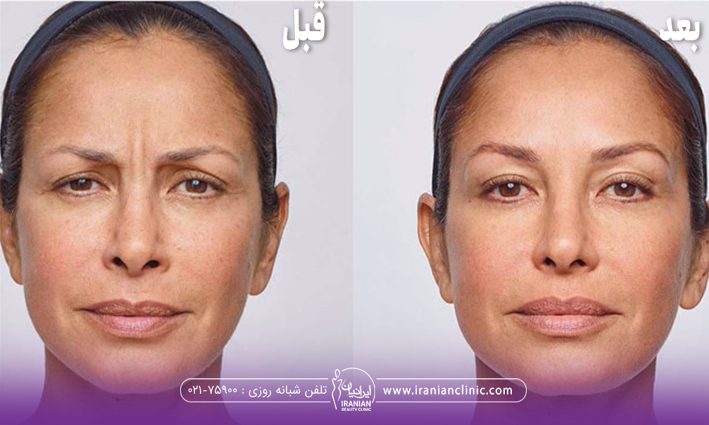 عک قبل و بعد فردی که در ناحیه پیشانی و خط اخم تزریق بوتاکس دیستون انجام داده است