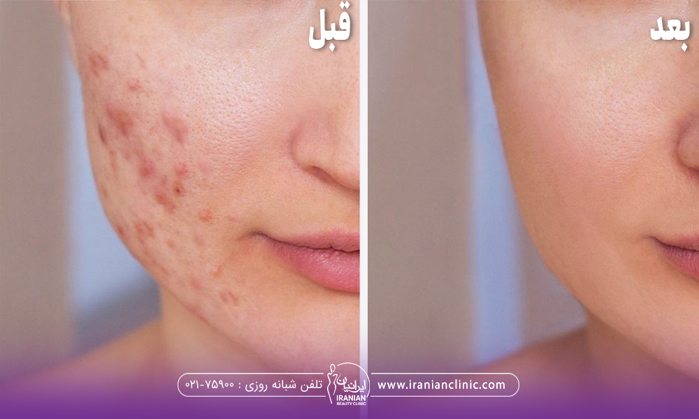 عکس قبل و بعد فردی که کربوسی تراپی جای جوش انجام داده است