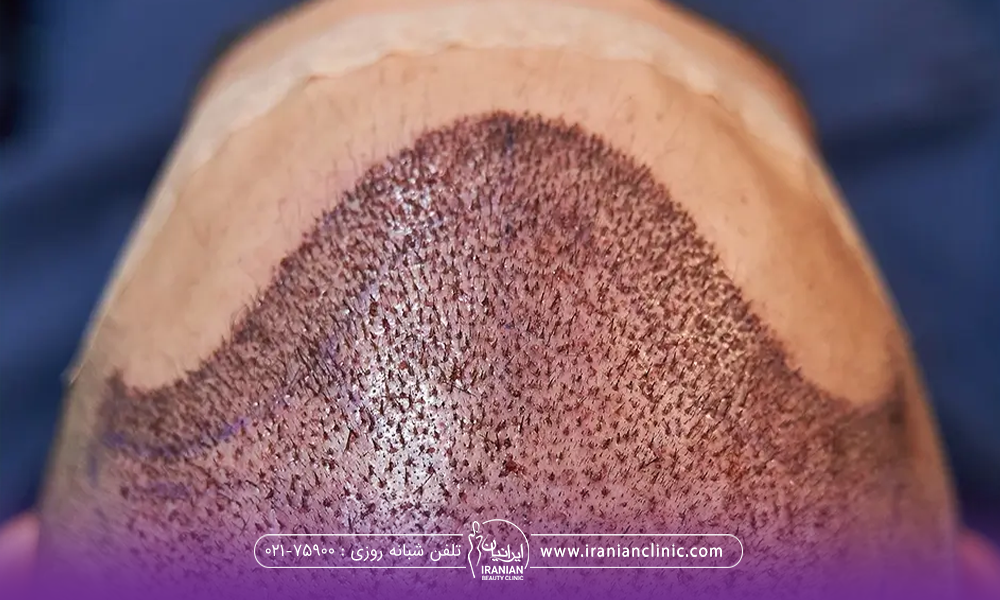 فردی که کاشت مو انجام داده است و پوست سر او در ناحیه کاشت قرمز و ملتهب شده است