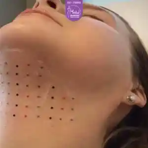 رفع غبغب با rf, فردی که خوابیده است و روی غبغبش نقطه نقطه است