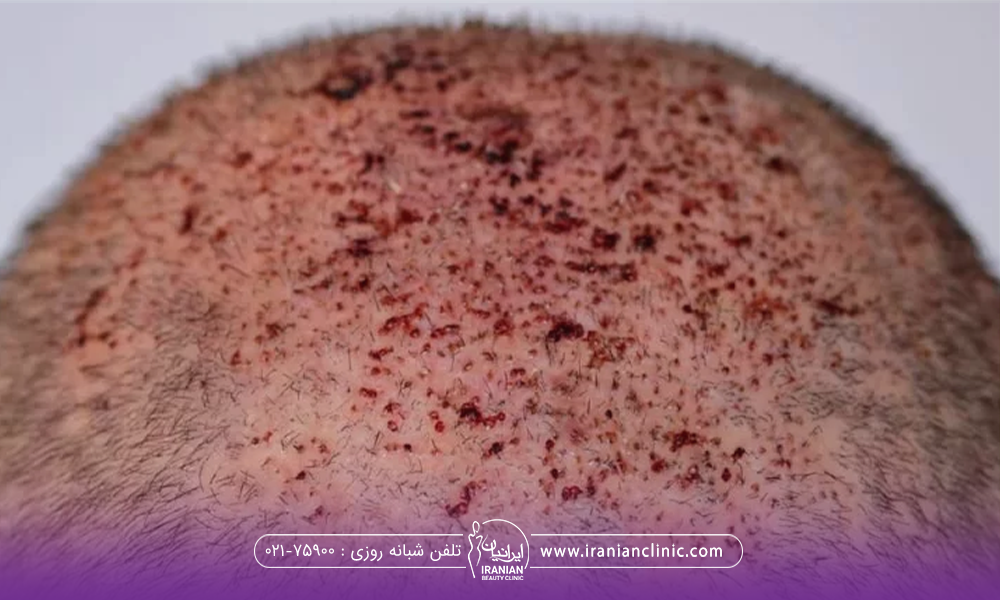 ایجاد زخم روی سر فرد بعد از انجام کاشت مو - زخم بعد از کاشت مو
