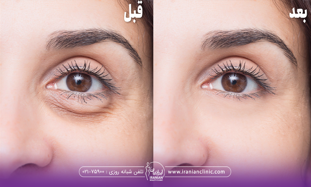 عکس ابروهای دختر قبل و بعد از اینکه کربوکسی تراپی انجام داده است