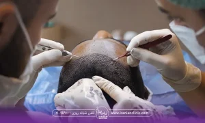 فردی که خوابیده و دستان دو دکتری که در حال کاشت مو روی سر فرد است - بهترین روش کاشت مو در ایران