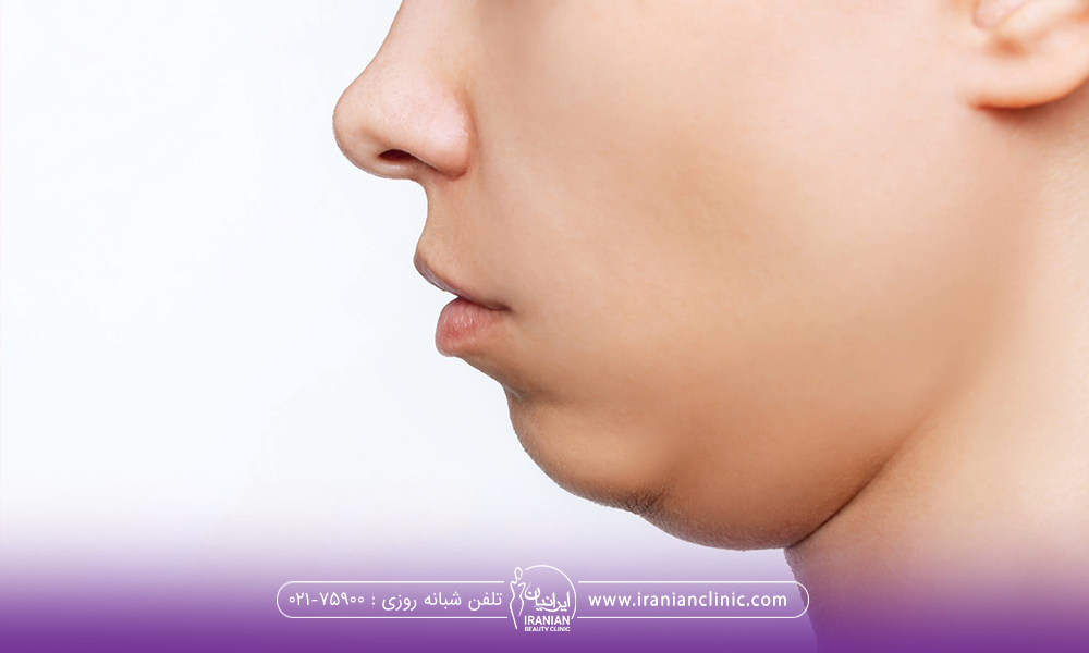عکس نیم رخ فردی که چربی موضعی در ناحیه غبغب دارد