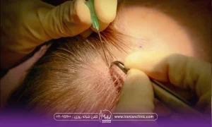 فردی که خوابیده و دستان دکتری که در حال انجام کاشت مو است - کاشت مو ناموفق​