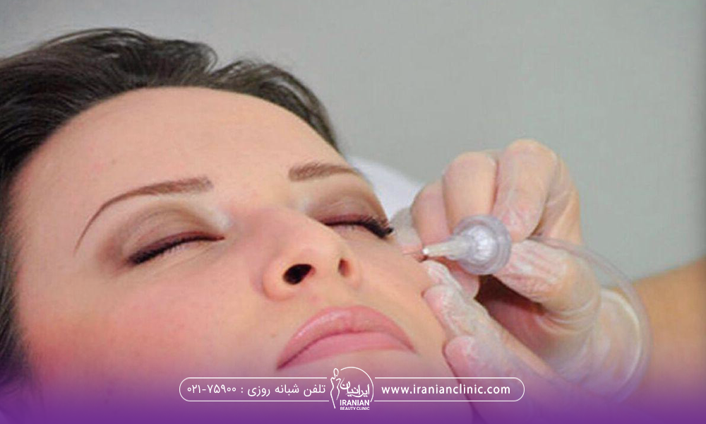 پزشکی که گونه و زیر چشم دختر را کربوکسی تراپی می کند