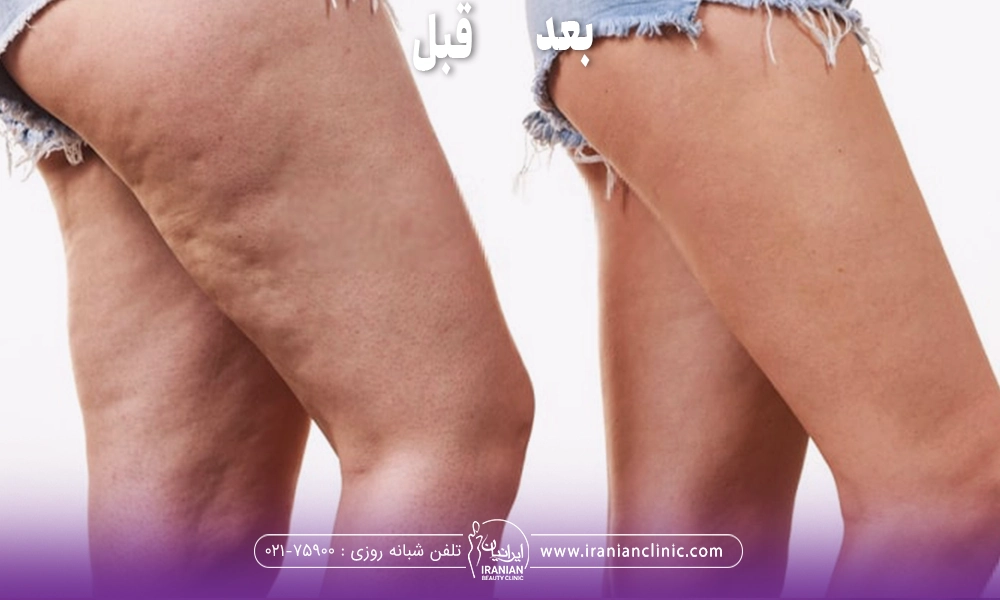 عکس قبل و بعد فردی که سلولیت پای خود را درمان کرده است
