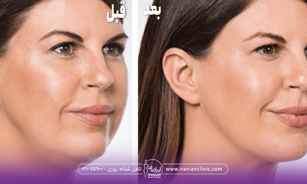 عکس قبل و بعد فردی که کروبسی غبغب انجام داده است