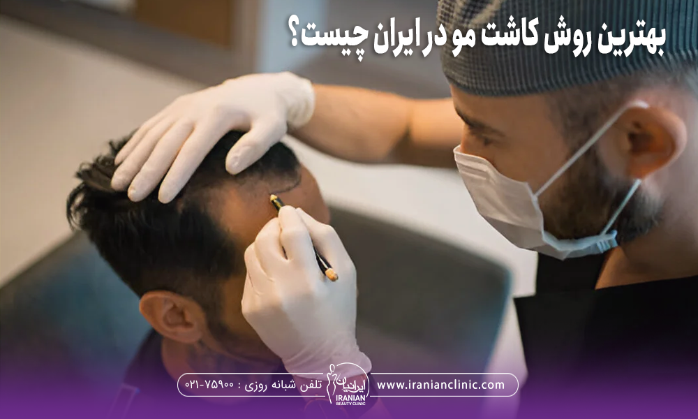 فردی که نشته است و دکتری که بالا سرش است و در حال علامت گذاری روی سر فرد است و روی عکس نوشته شده است بهترین روش کاشت مو در ایران چیست
