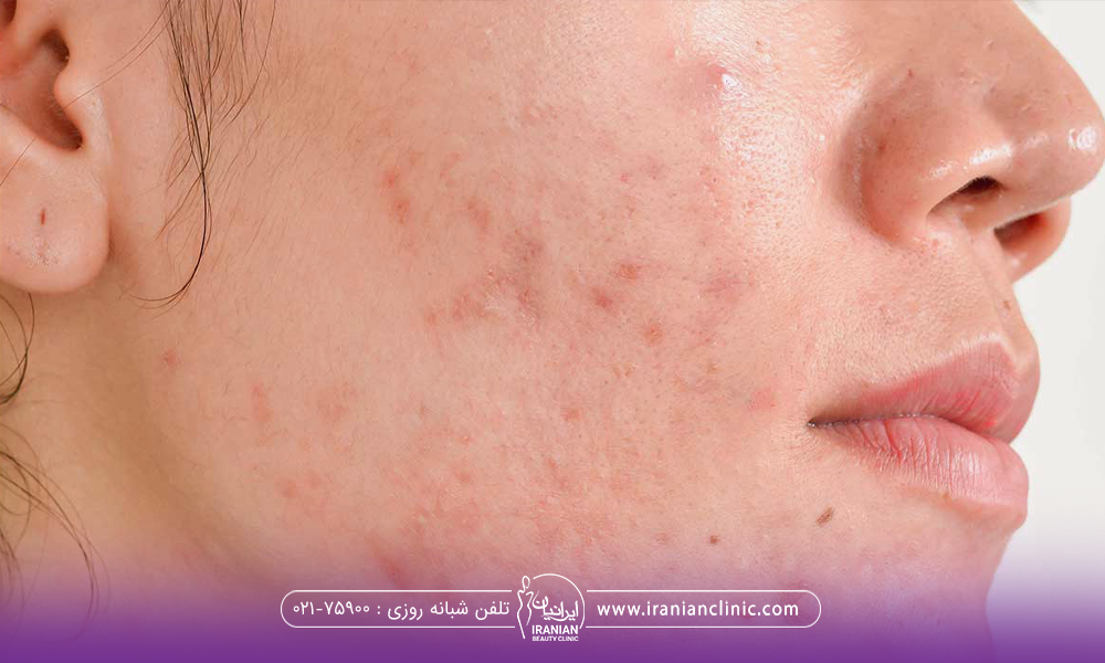 یک طرف صورت فردی که پر جوش است