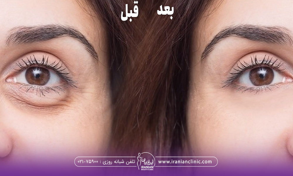 عکس قبل و بعد فردی که کربوکسی تراپی انجام داده است