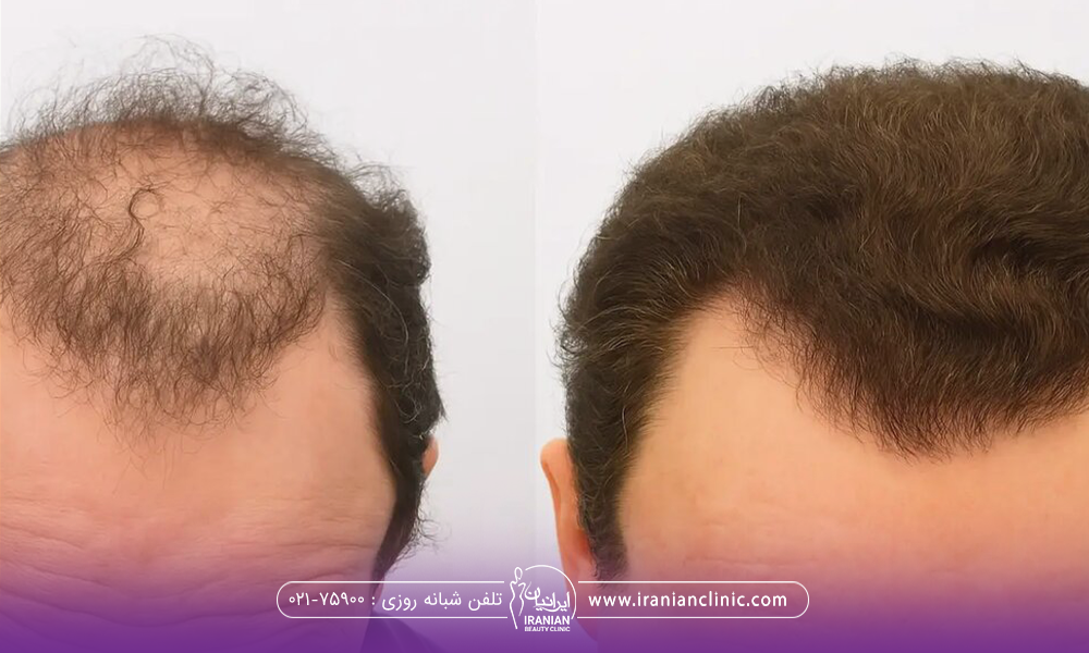 عکس قبل و بعد فردی  کاشت مو انجام داده است