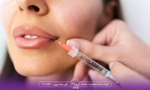 پزشکی که به گوشه لب بالای دختر ژل تزریق می کند - هزینه تزریق فیلر