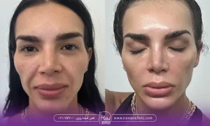 عکس قبل و بعد تزریق فیلر خط خنده به صورت زن - ماساژ بعد از تزریق ژل خط خنده