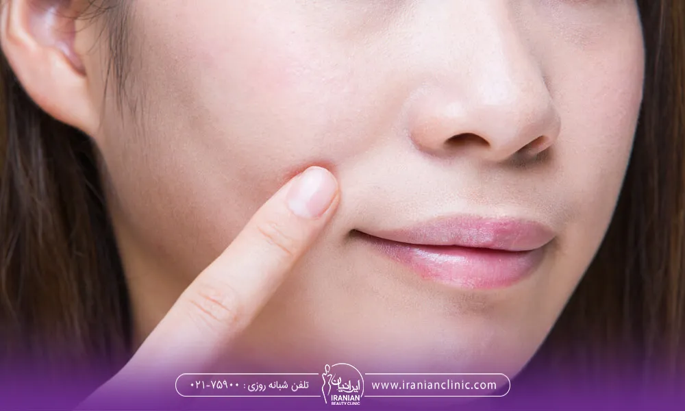 دختری که با انگشت به خط لبخند اشاره می کند - ورم بعد از تزریق ژل خط خنده