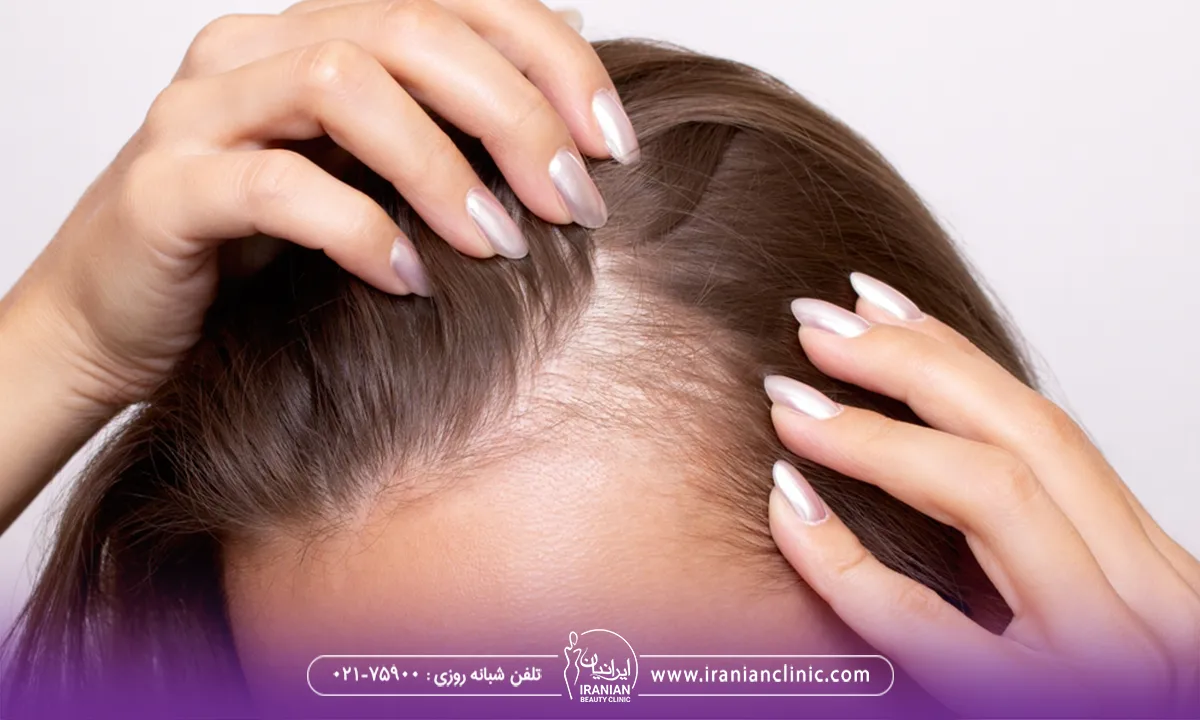 علائم و ویژگی های بالینی ریزش مو