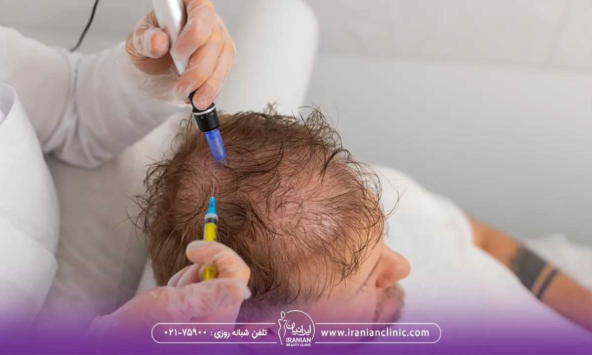 میکرونیدلینگ پوست سر