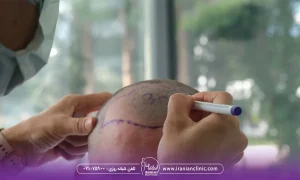 مقایسهٔ روش‌ های کاشت مو