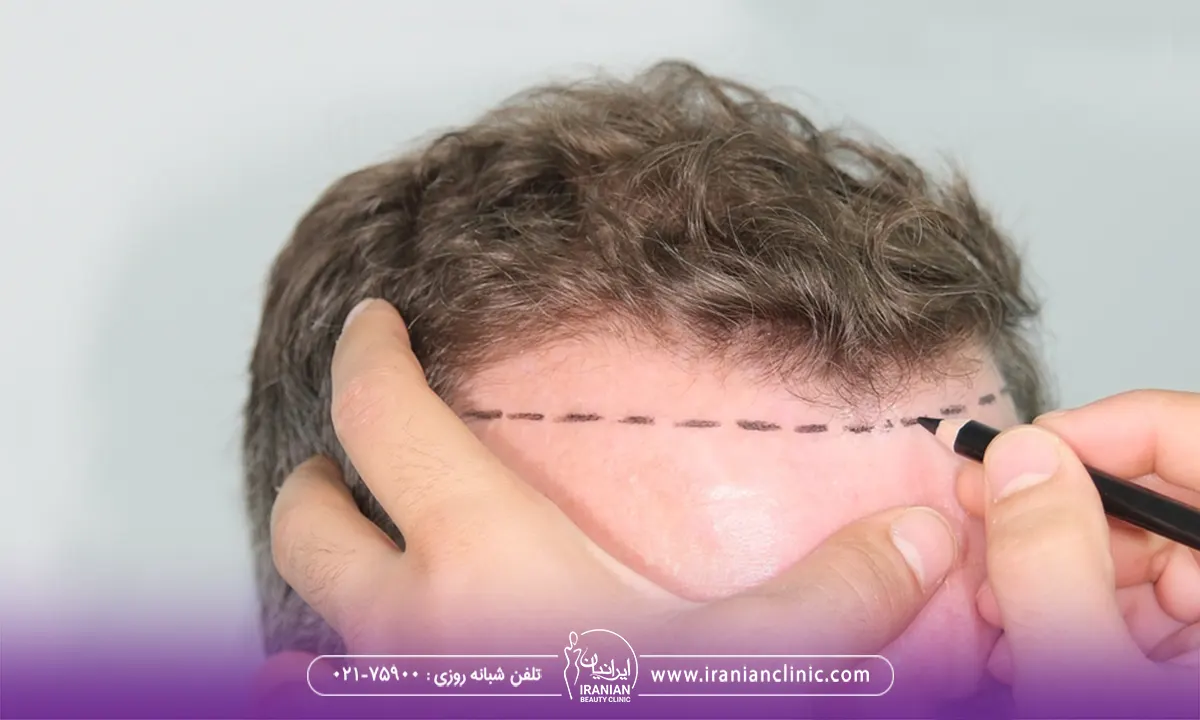 روش FUT (پیوند واحد فولیکولی)