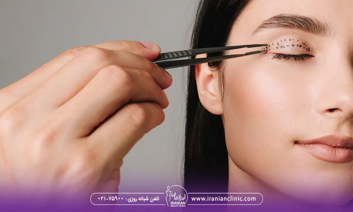 تفاوت کانتوپلاستی و بلفاروپلاستی