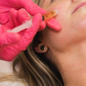 PRP سوپر (یک جلسه) با ۳ میلیون تخفیف ویژه