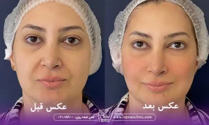 عکس قبل و بعد هایفوتراپی ابرو و صورت