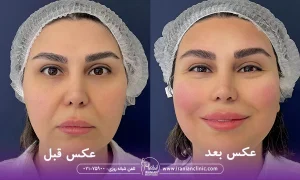خانمی که هایفو کامل صورت را در کلینیک زیبایی ایرانیان انجام دادند