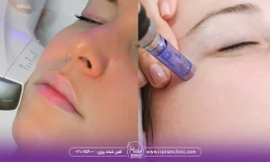 هایفوتراپی بهتره یا میکرونیدلینگ، کدام مناسب تر است؟
