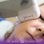 خانمی درحال برطرف کردن لک صورت و جوانسازی پوست صورت با هایفوتراپی، هایفوتراپی برای لک صورت چقدر تاثیر دارد؟